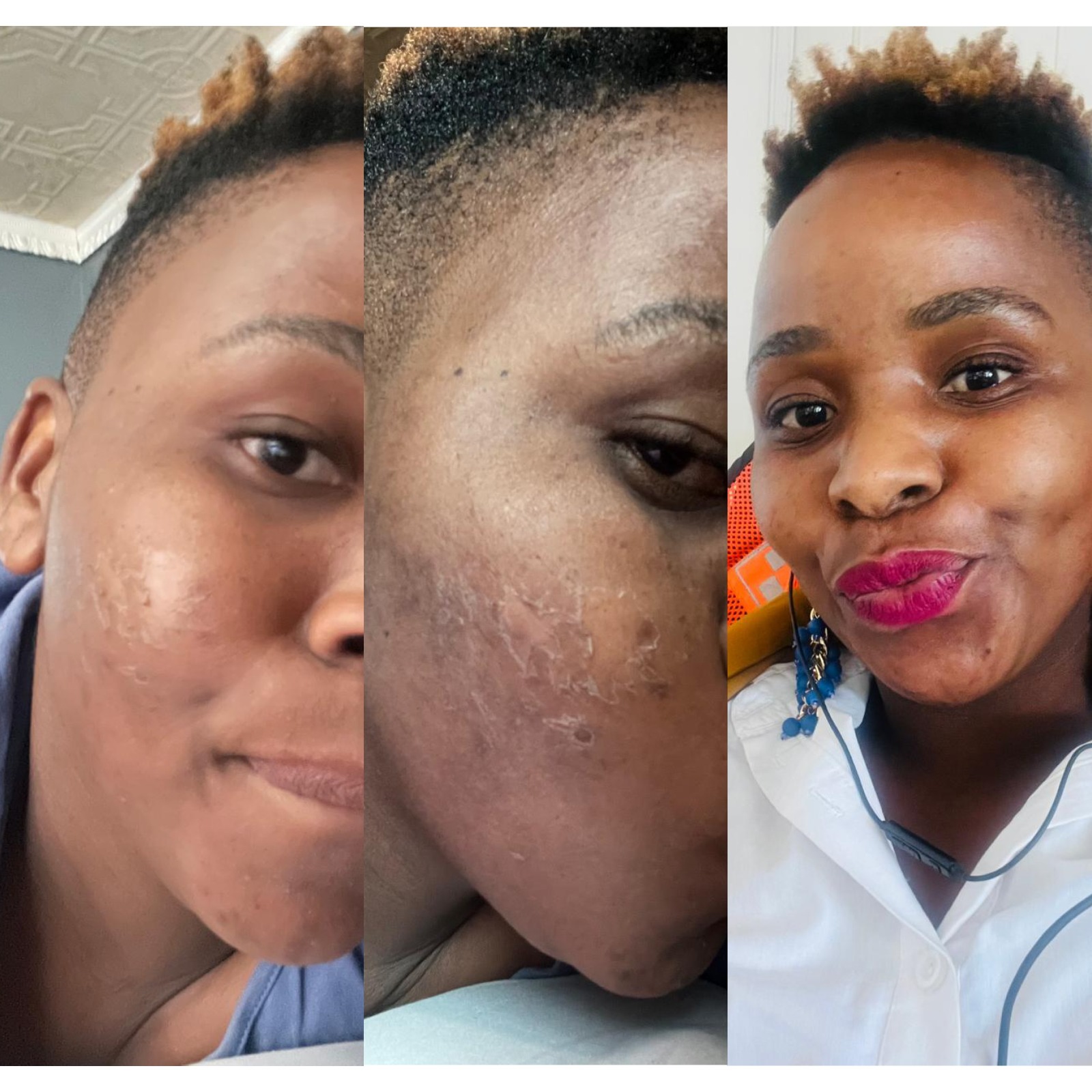 Algae Peel before and after client transformation